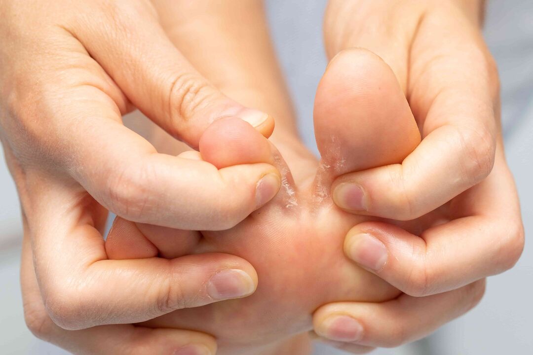Mushrooms between ZXCVBNMQWert Cream and its Treatment between His Treatment