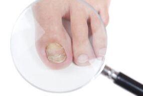 Reasons for nail fungi