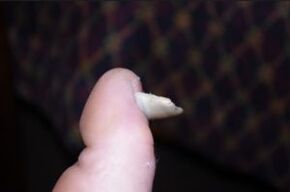 Symptoms of fungi in the nail