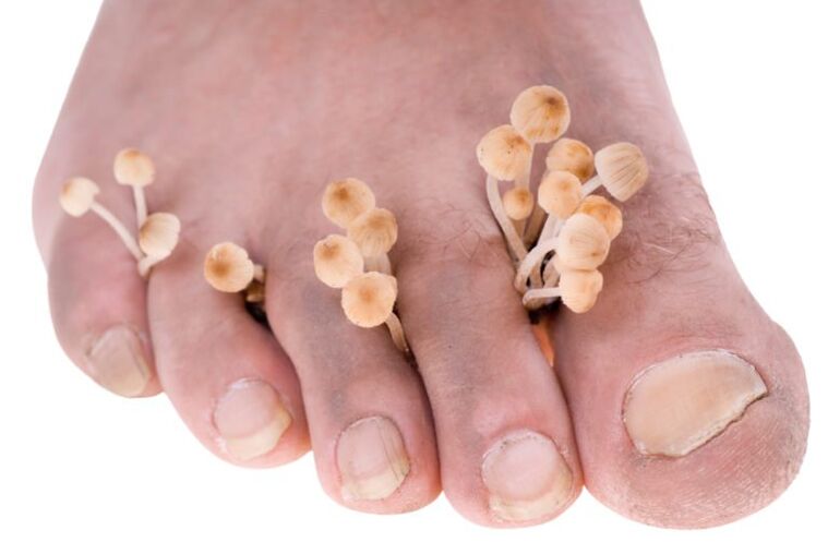 Mushrooms in the legs symptoms