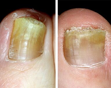 Distal form of onychomycosis in the legs