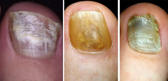 In the photo, a change in the color of the nails on the foot with fungal disease
