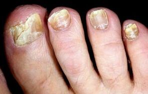 Symptoms of nail fungus